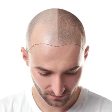 Micropigmentation: The Hair Loss Solution You’ve Been Searching For