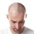 Micropigmentation: The Hair Loss Solution You’ve Been Searching For