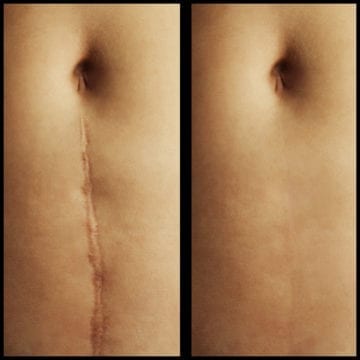 What Makes Scar Camouflage a Great Treatment Option?!?