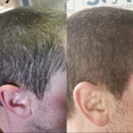 Before and after men's micropigmentation The Woodlands TX